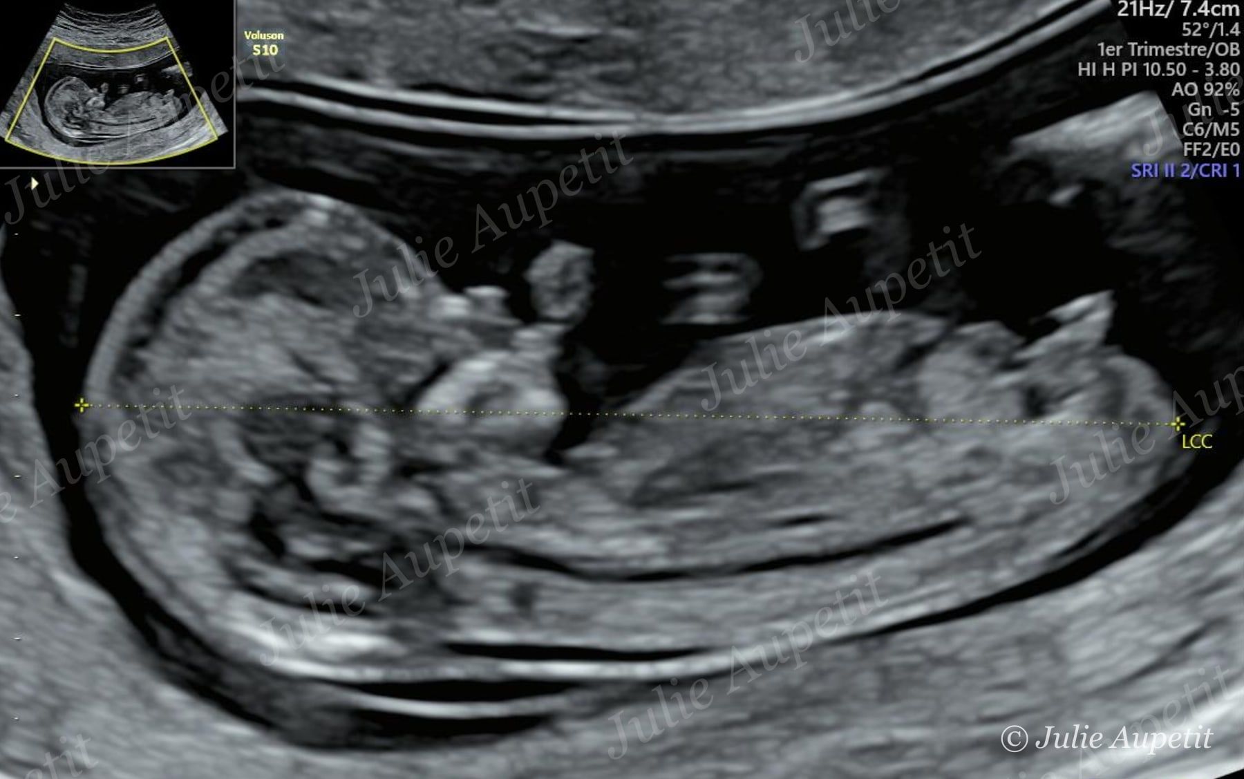 Échographie du premier trimestre : bébé de profil avec mesure de la longueur cranio-caudale