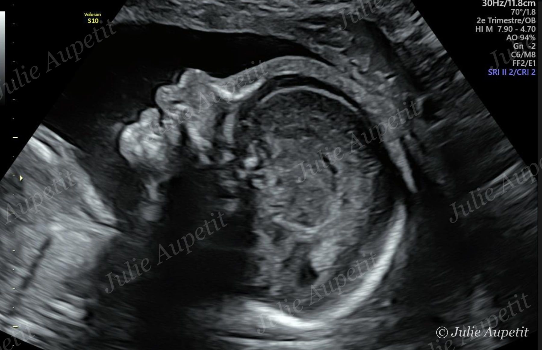 Échographie morphologique du deuxième trimestre : profil du bébé
