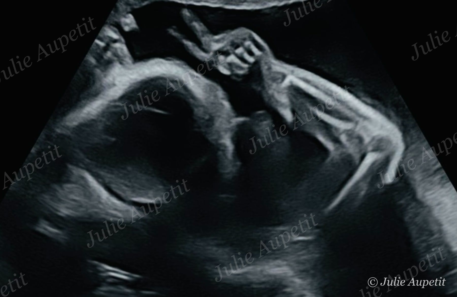 Échographie du troisième trimestre : bébé la main près du visage